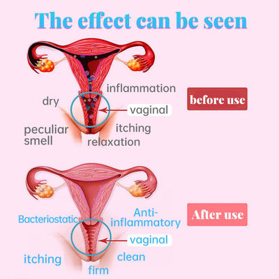 Produtos de cuidados vaginais para a saúde da mulher Função de estreitamento da vagina 2 anos de validade